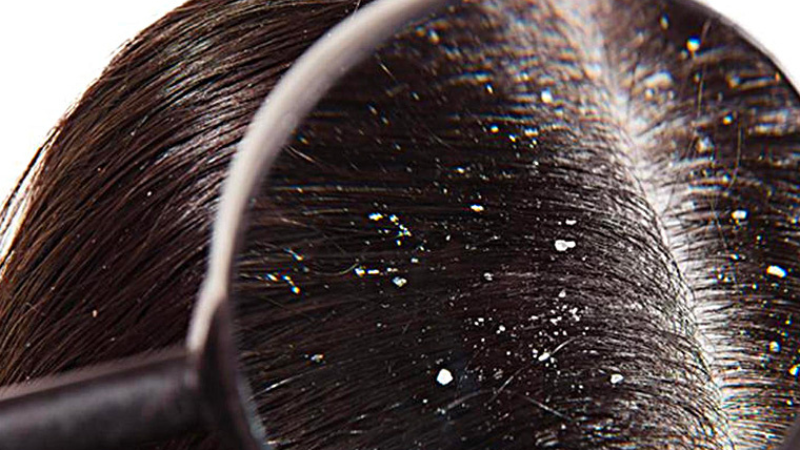 Top 11 cách trị gàu da đầu bạn cần biết