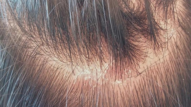 Nấm da đầu có lây không? Cách điều trị và ngăn ngừa lây lan nấm da đầu hiệu quả