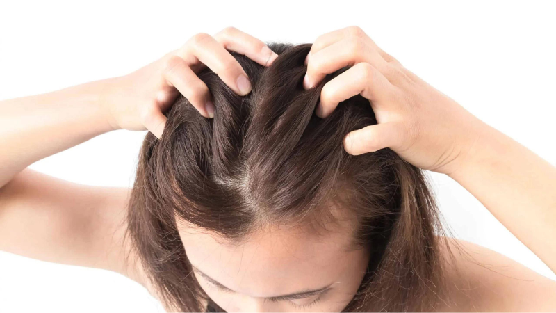 Bị ngứa da đầu nhưng không có gàu - Nguyên nhân và cách khắc phục hiệu quả