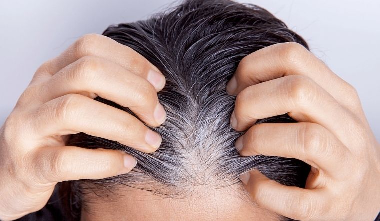 Dấu hiệu hói đầu