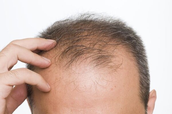 Rụng tóc telogen là gì?
