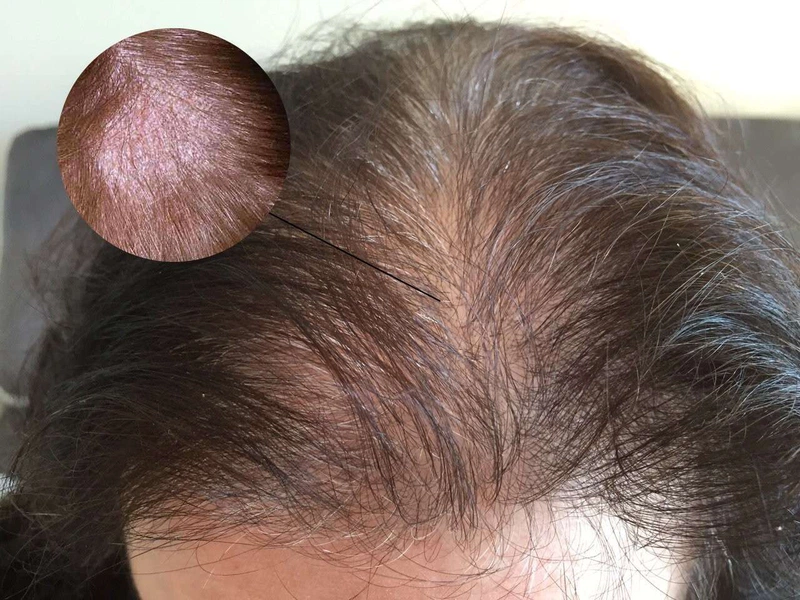Da đầu nhờn rụng tóc