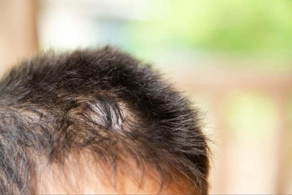 Nấm da đầu gây ra phản ứng viêm mạnh