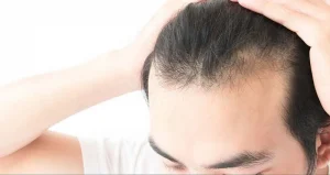 Nguyên nhân tăng dht gây rụng tóc ở nam giới 