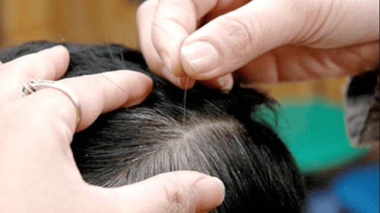 Các bệnh lý có thể là nguyên nhân gây bạc tóc ở trẻ em