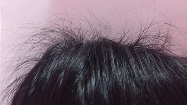 Tóc mọc ngược gây ngứa