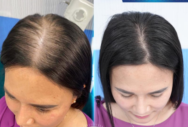 Tăng sinh mầm tóc là gì? Chi phí tăng sinh mầm tóc là bao nhiêu?