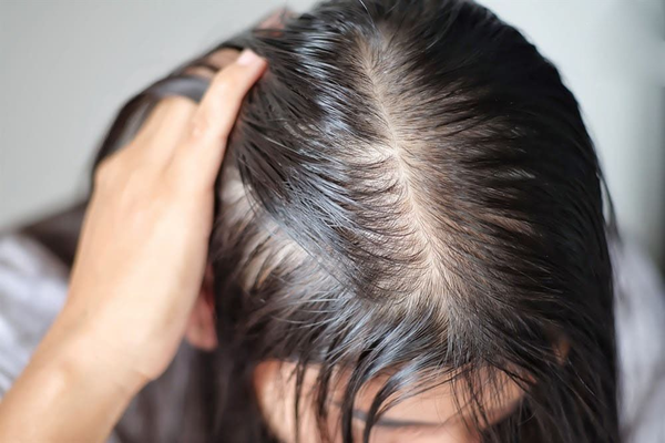 Bi hói ở đỉnh đầu nữ: Nguyên nhân và cách khắc phục hiệu quả