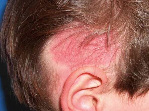 Da đầu bị đỏ do đâu? Nguyên nhân thường gặp và cách điều trị dễ nhất