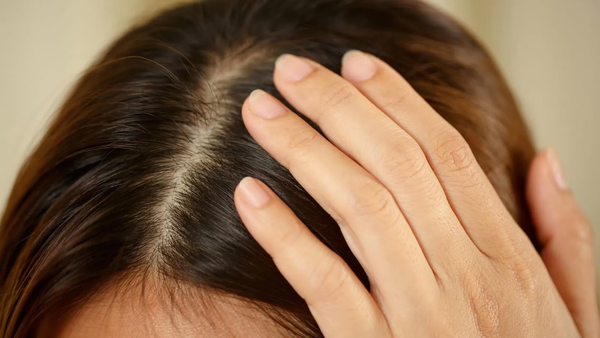 Mật độ tóc là chỉ số đo lường số lượng sợi tóc trên da đầu