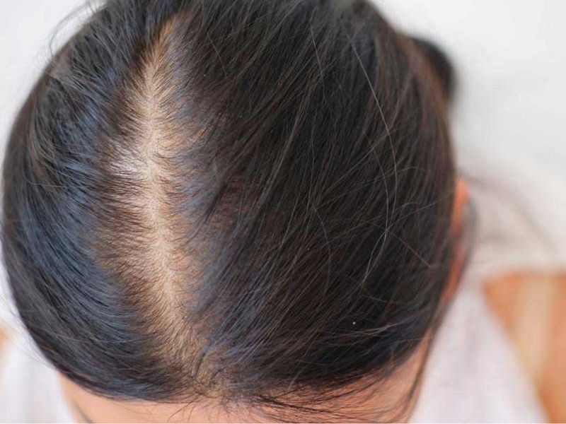 Chân tóc yếu thiếu chất gì?
